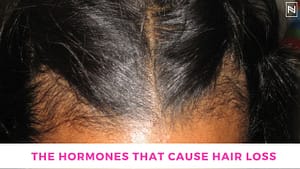 Hormonal Imbalances and Hair Loss