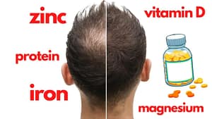 Nutritional Deficiencies and Hair Loss