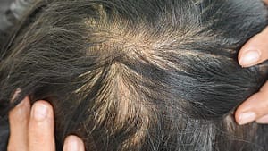 Stress and Hair Loss
