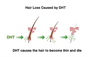 Hair Loss and Hormones