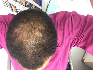 Hair Loss in Men