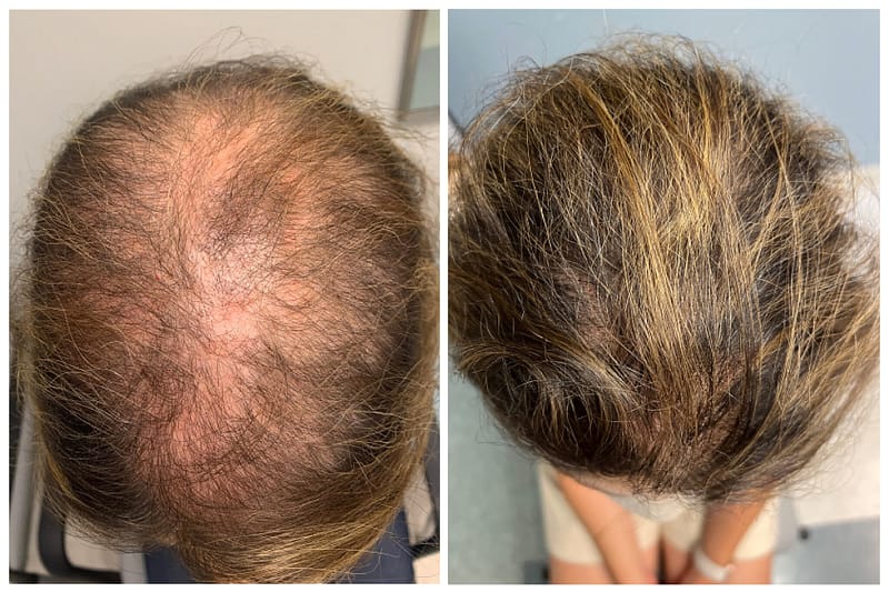Hair Loss Due to Medication