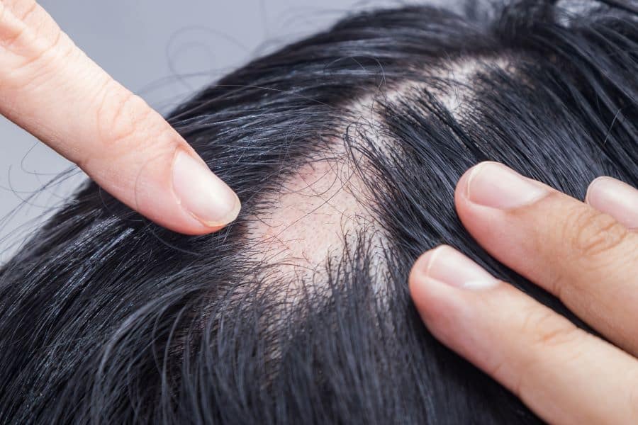 Understanding Alopecia Areata Causes and Treatments
