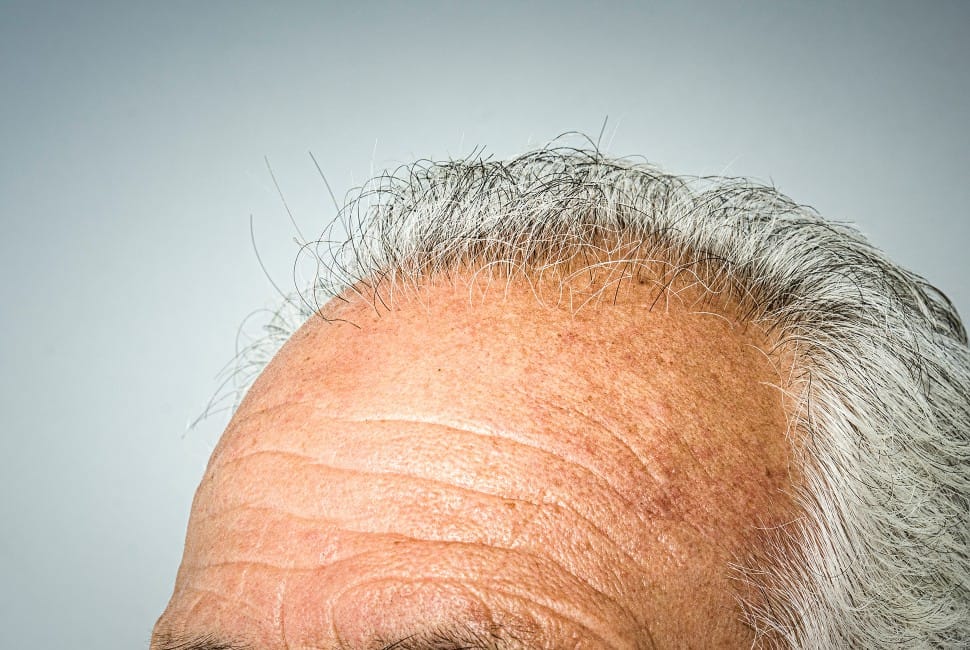 Hair Loss and Aging